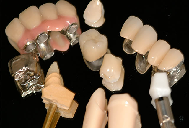 هزینه پروتزهای دندانی
