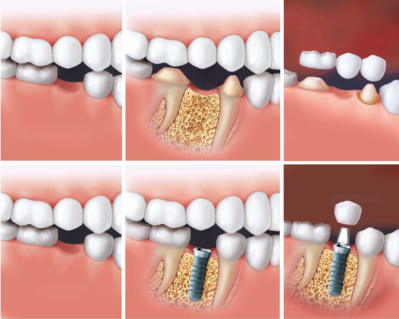 مراحل ایمپلنت یک دندان