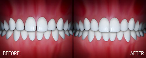 هزینه بستن فاصله بین دندان