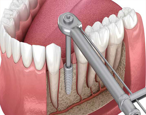 هزینه ایمپلنت دندان
