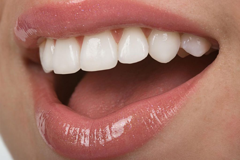 متخصص بلیچینگ دندان در کرج
