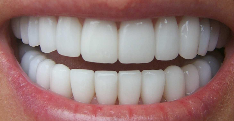 انواع روکش های سرامیکی دندان 