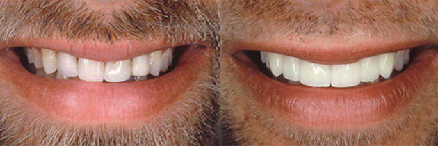 متخصص کامپوزیت دندان در کرج