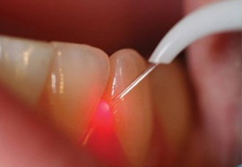 دوره فلوشیپ لیزر در دندانپزشکی