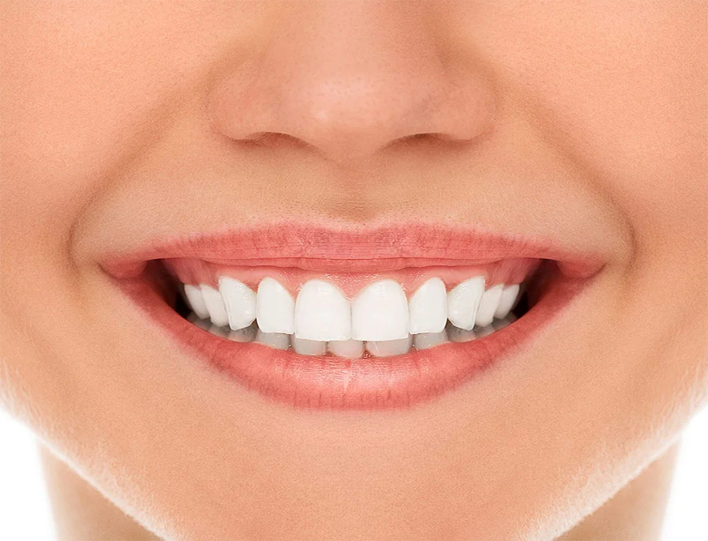 بازسازی طراحی خط لب و شلوغی های دندانی محدود (لمینیت )