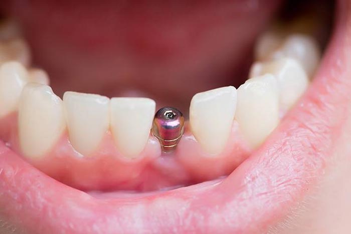 طول درمان ایمپلنت دندان
