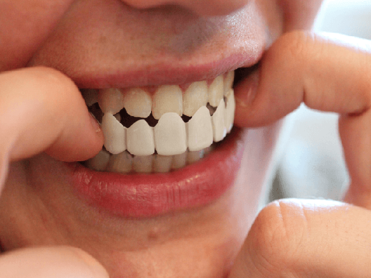 قیمت پروتز ثابت دندان در کرج