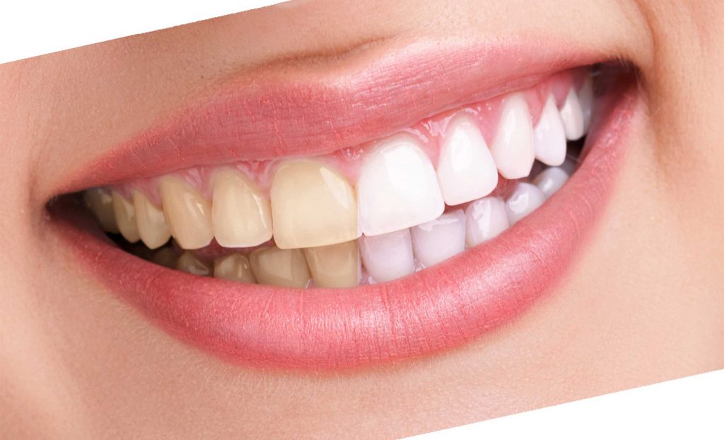 متخصص بلیچینگ دندان در کرج