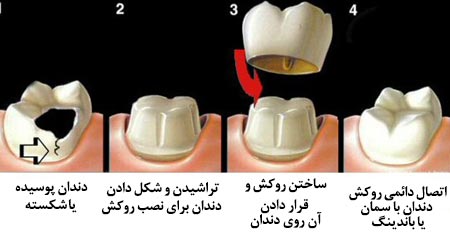 متخصص روکش دندان در کرج